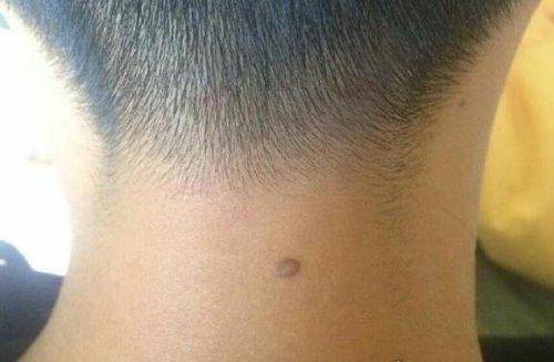 为啥有的人脖子后边有一颗"痣"?是好是坏?真的是巧合吗?