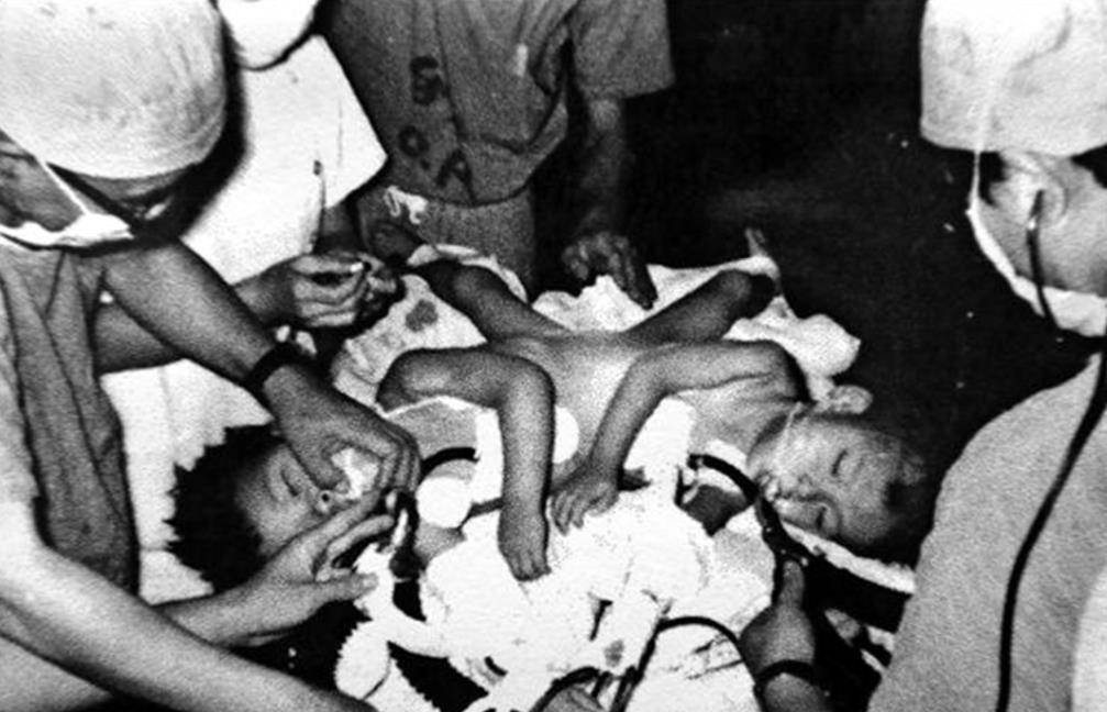 故事:1979年台湾连体兄弟成功分割,弟弟娶妻生子,哥哥英年早逝