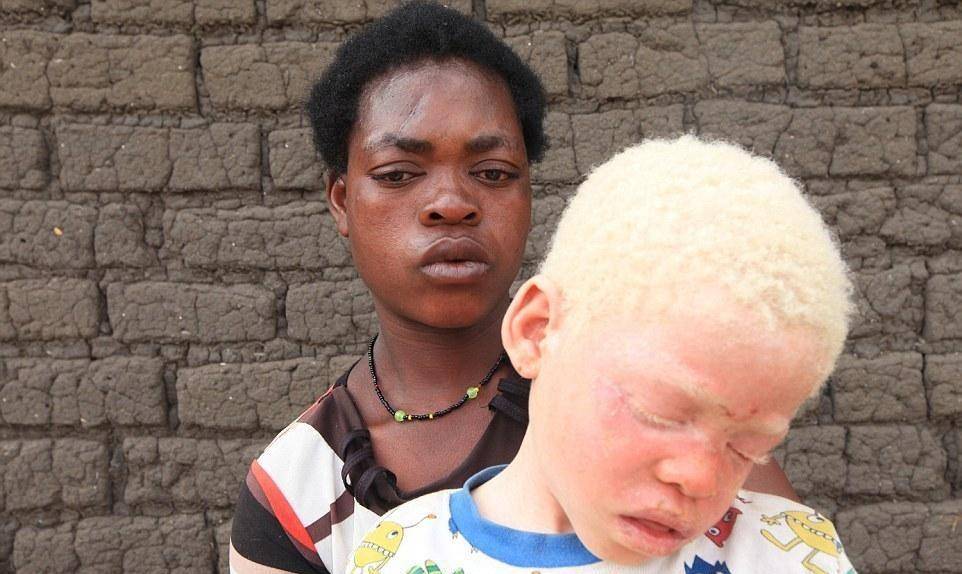 但迄今为止,在地球上仍然有部分地区对白化病患者采取着歧视,乃至是