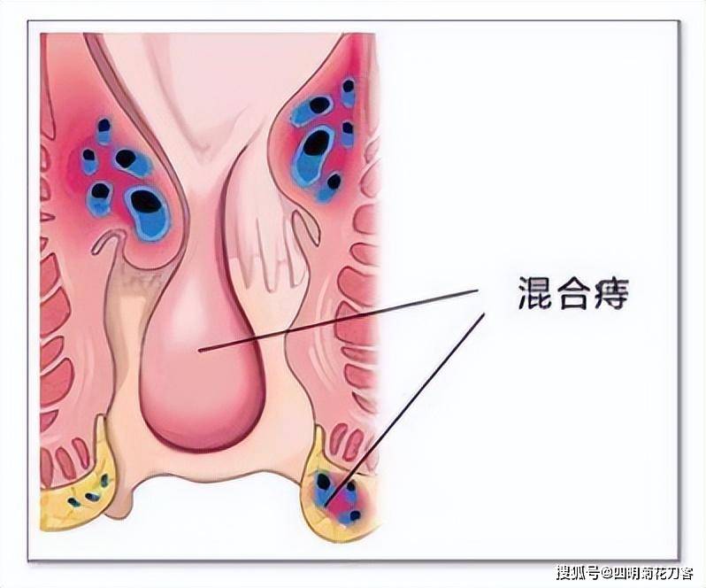 肛门疾病有哪些图片