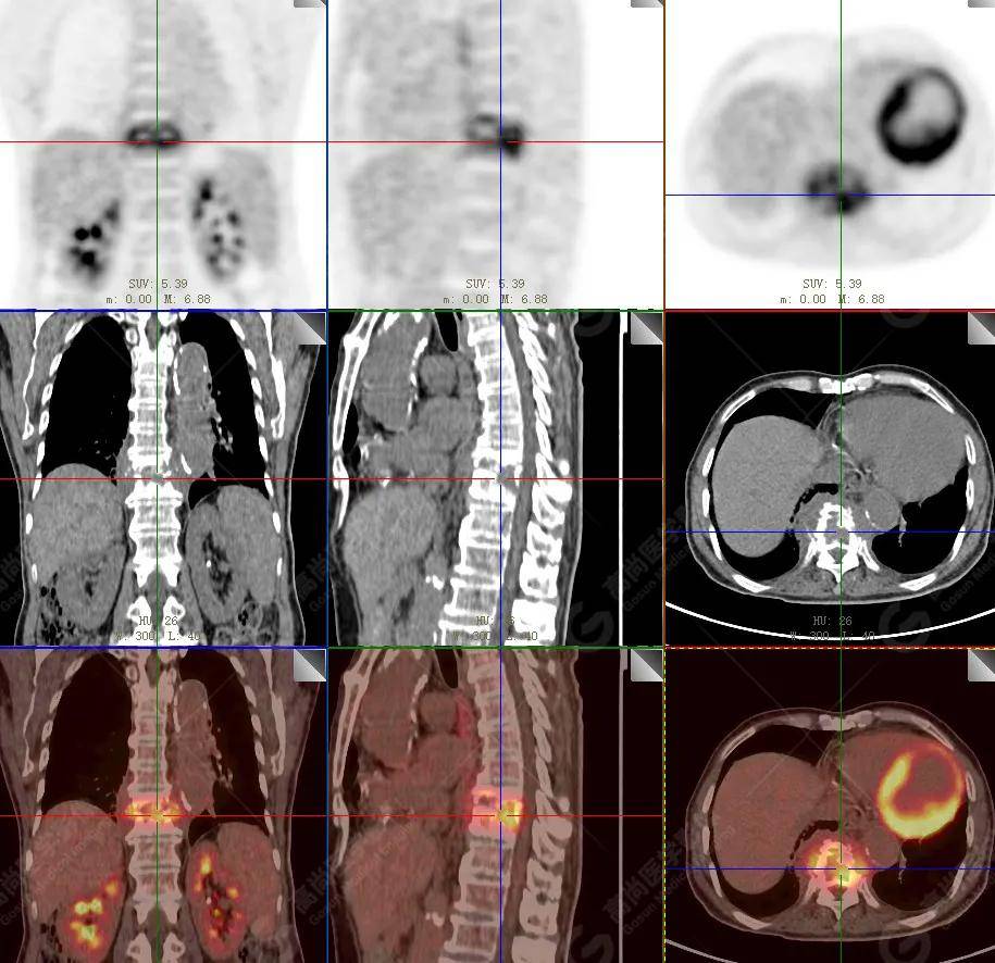 【高尚病例】18f-fdg pet/ct显像应用于骨结核
