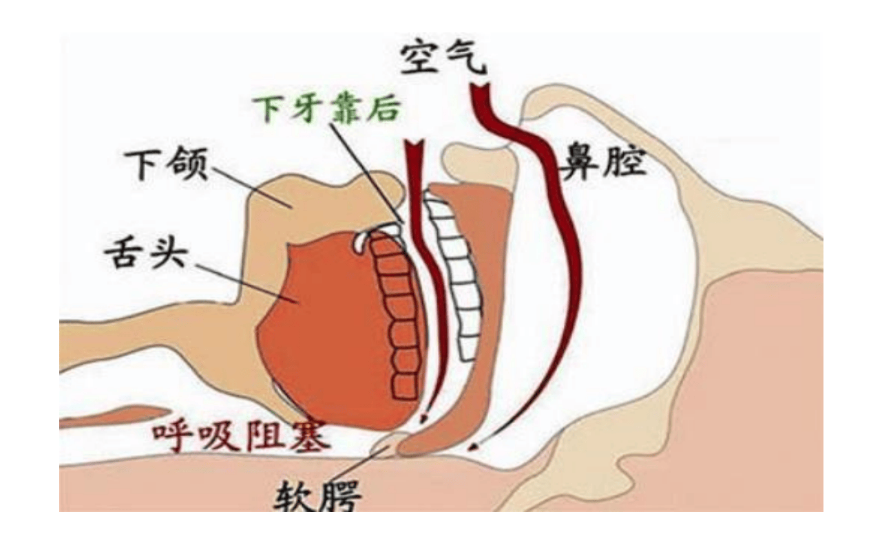 打鼾原理图片