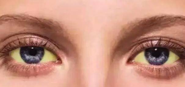 眼睛发黄是什么原因图片