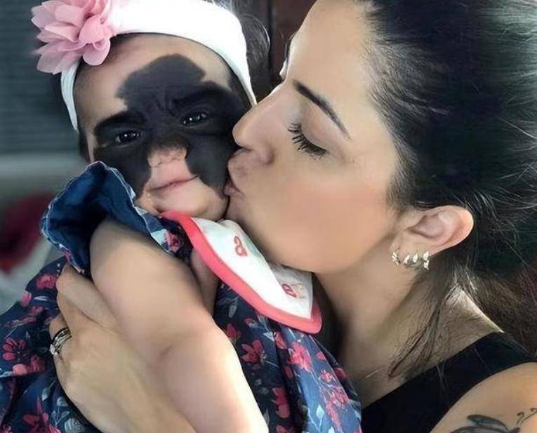 还记得天生胎记酷似"蝙蝠侠"的女婴吗?6次整容后,仍需治疗