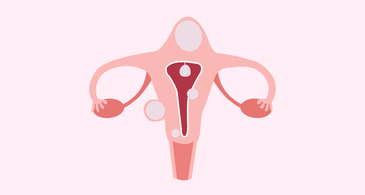 子宫肌瘤有哪几种类型？患有子宫肌瘤,有生育要求,怎么治疗