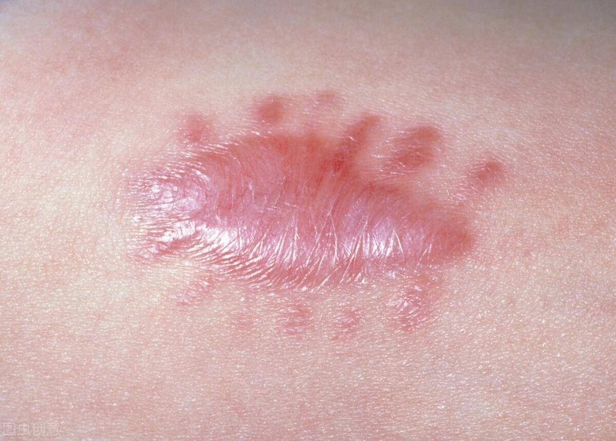 如何预防疤痕?重组Ⅲ型人源化胶原蛋白预防疤痕形成!