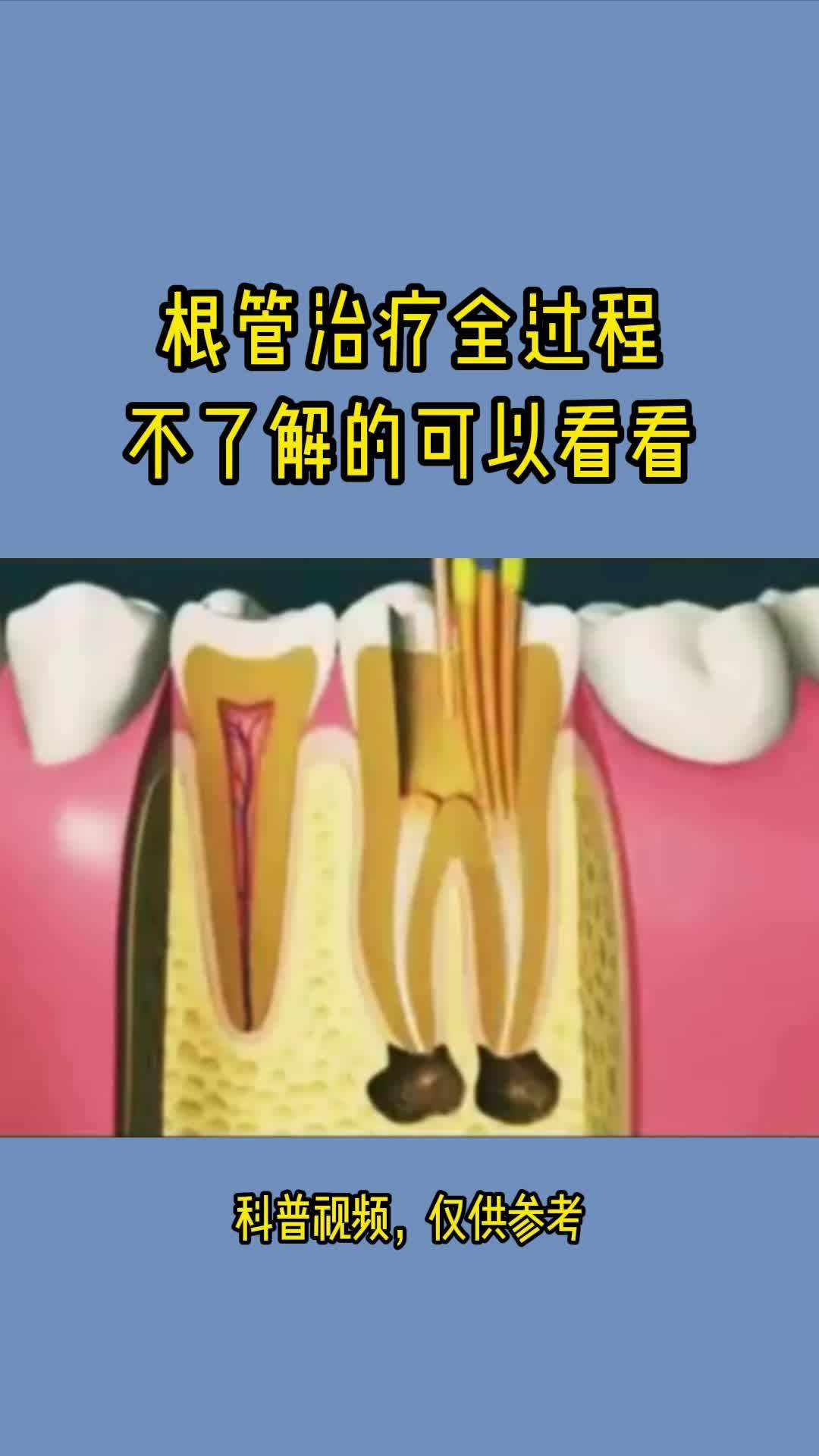 根管治疗全过程示意图