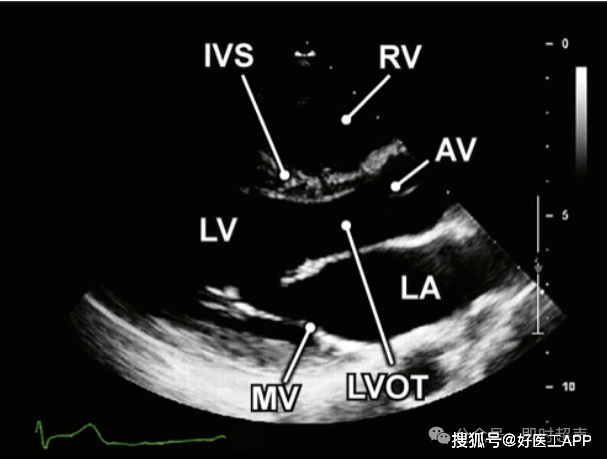床旁超声心动图的基本测量