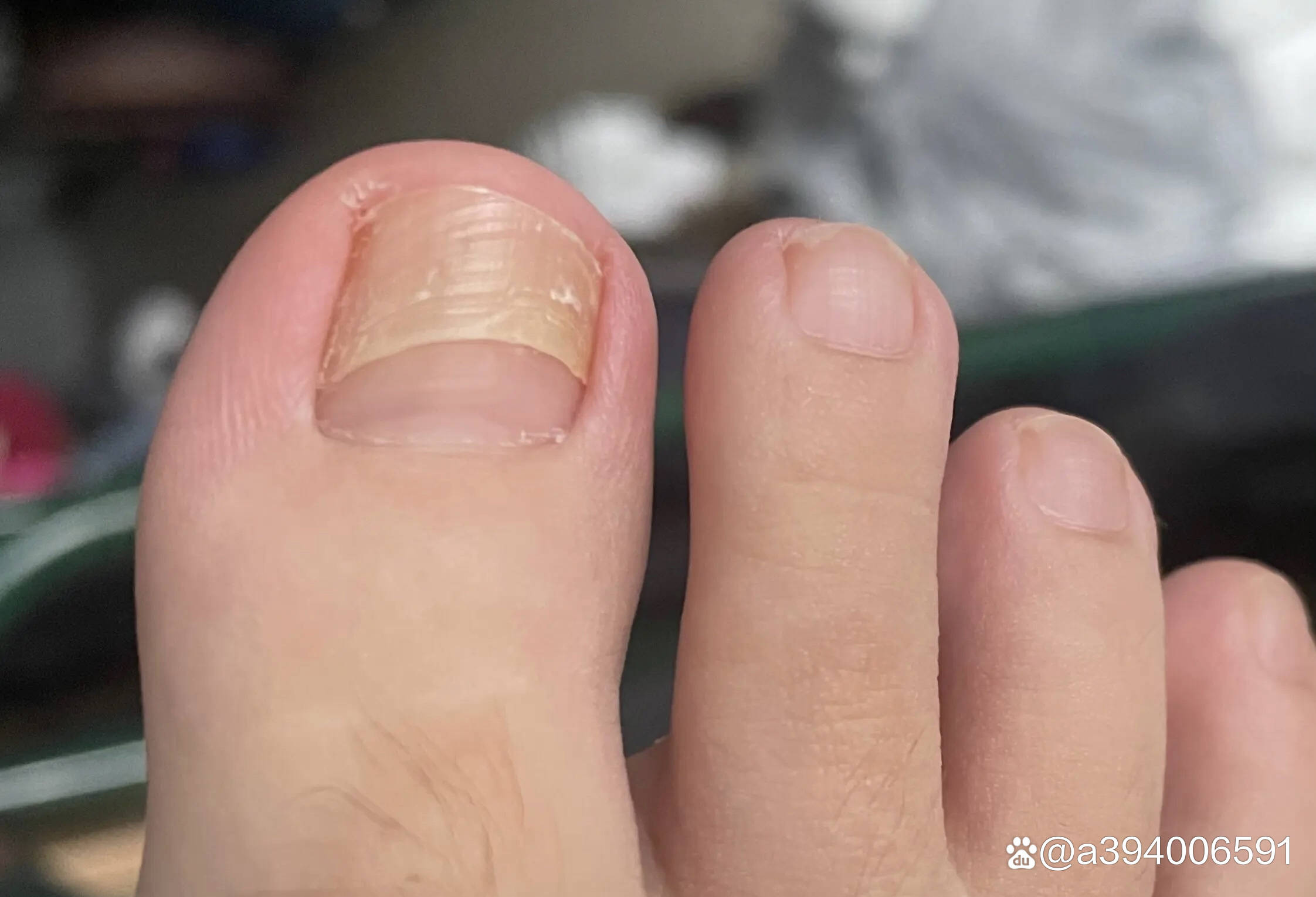 1-4月治好灰指甲经历(超详细)_真菌_时间_感觉