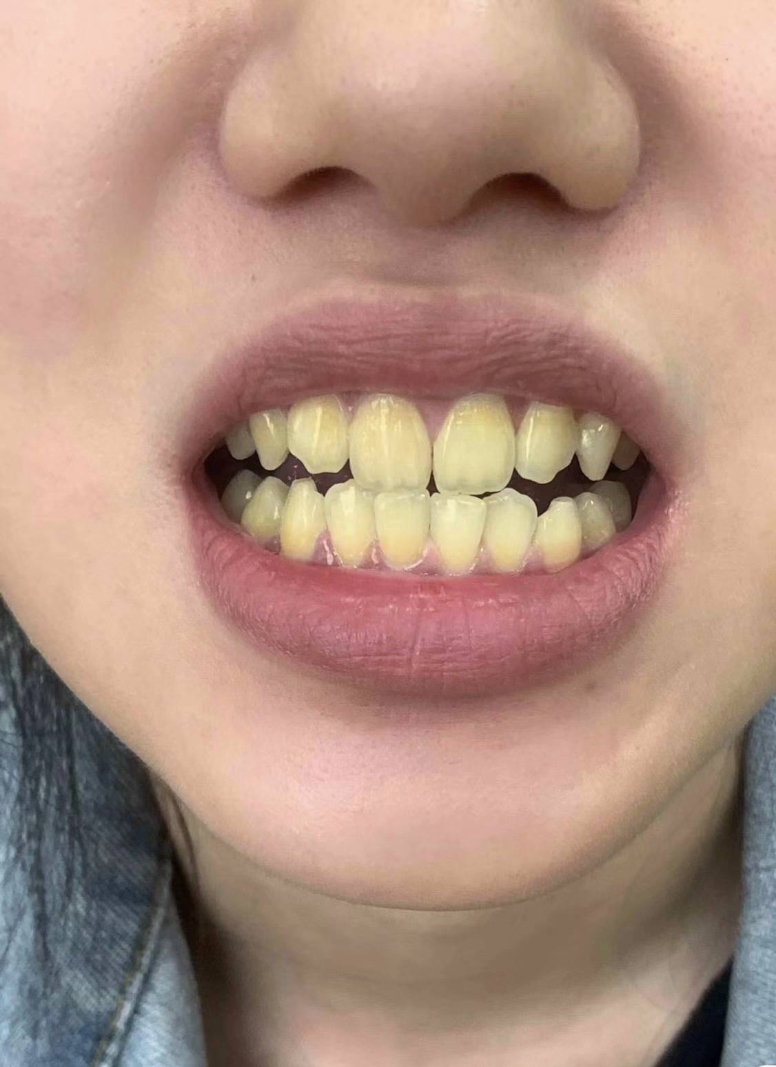 别担心!看完这篇帮你洁白牙齿不是问题!