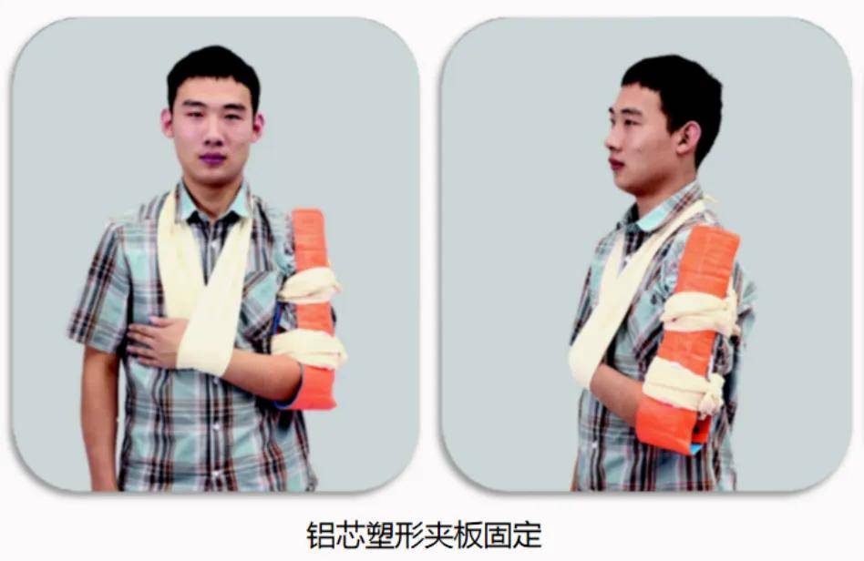 骨折固定有哪些方法