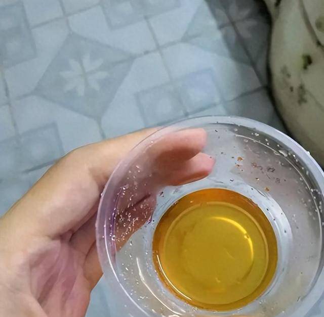 女性尿颜色像茶水图片