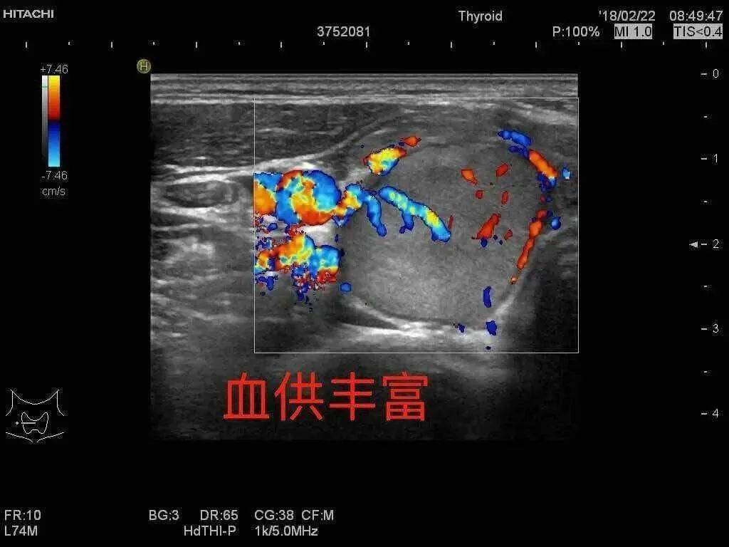 甲状腺上下动脉超声图图片