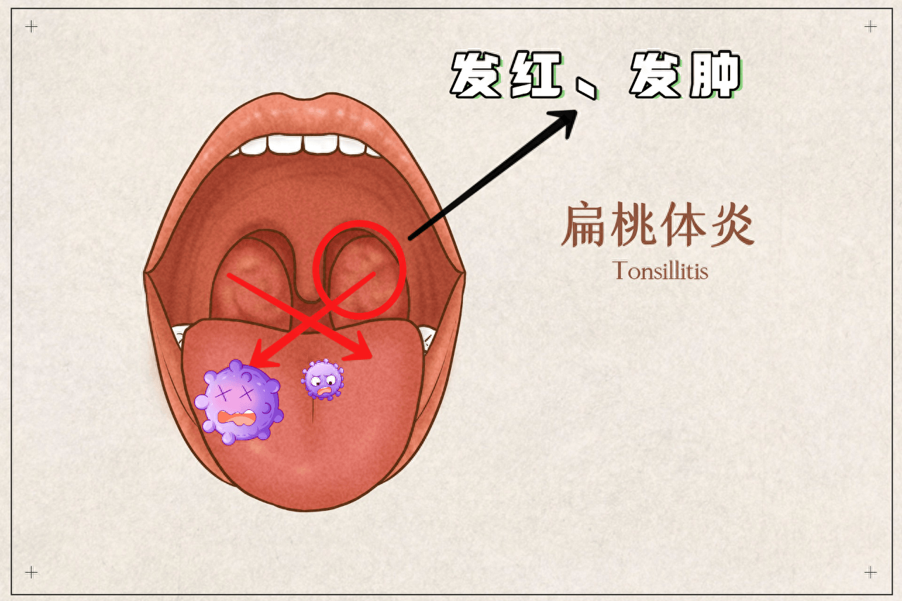 扁桃体发炎的原因图片