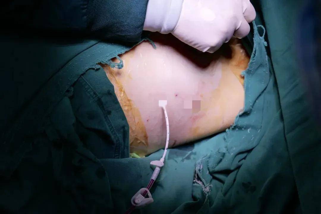 2毫米小创口就能解决肥厚性心肌病