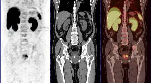 尿频2年多,psma pet/ct诊断前列腺癌