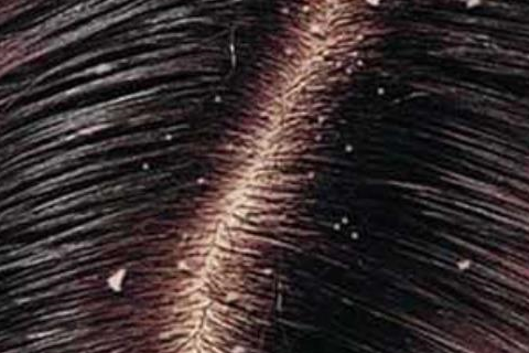 头发有这4种变化时,可能是头皮有螨虫在使坏,别大意