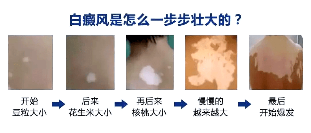 白癜风的双重斗争:皮肤病变与心理创伤的交织