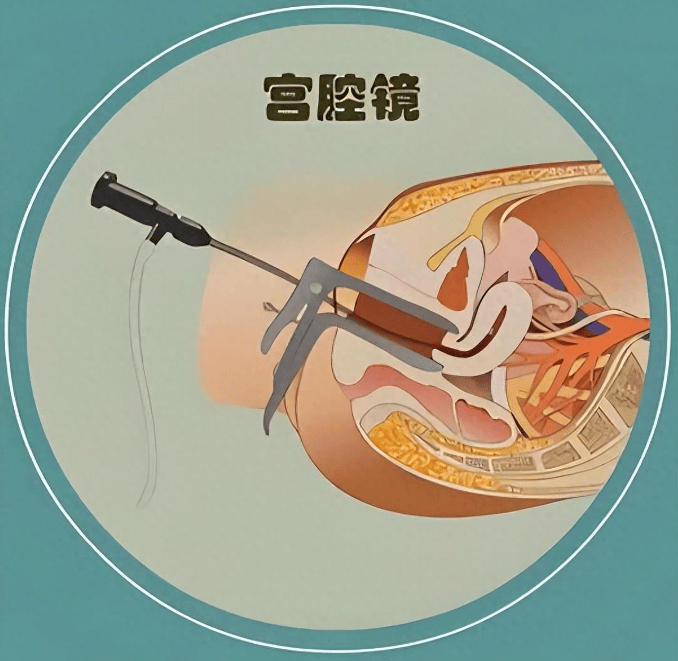 丹东妇科 助孕神器——宫腔镜