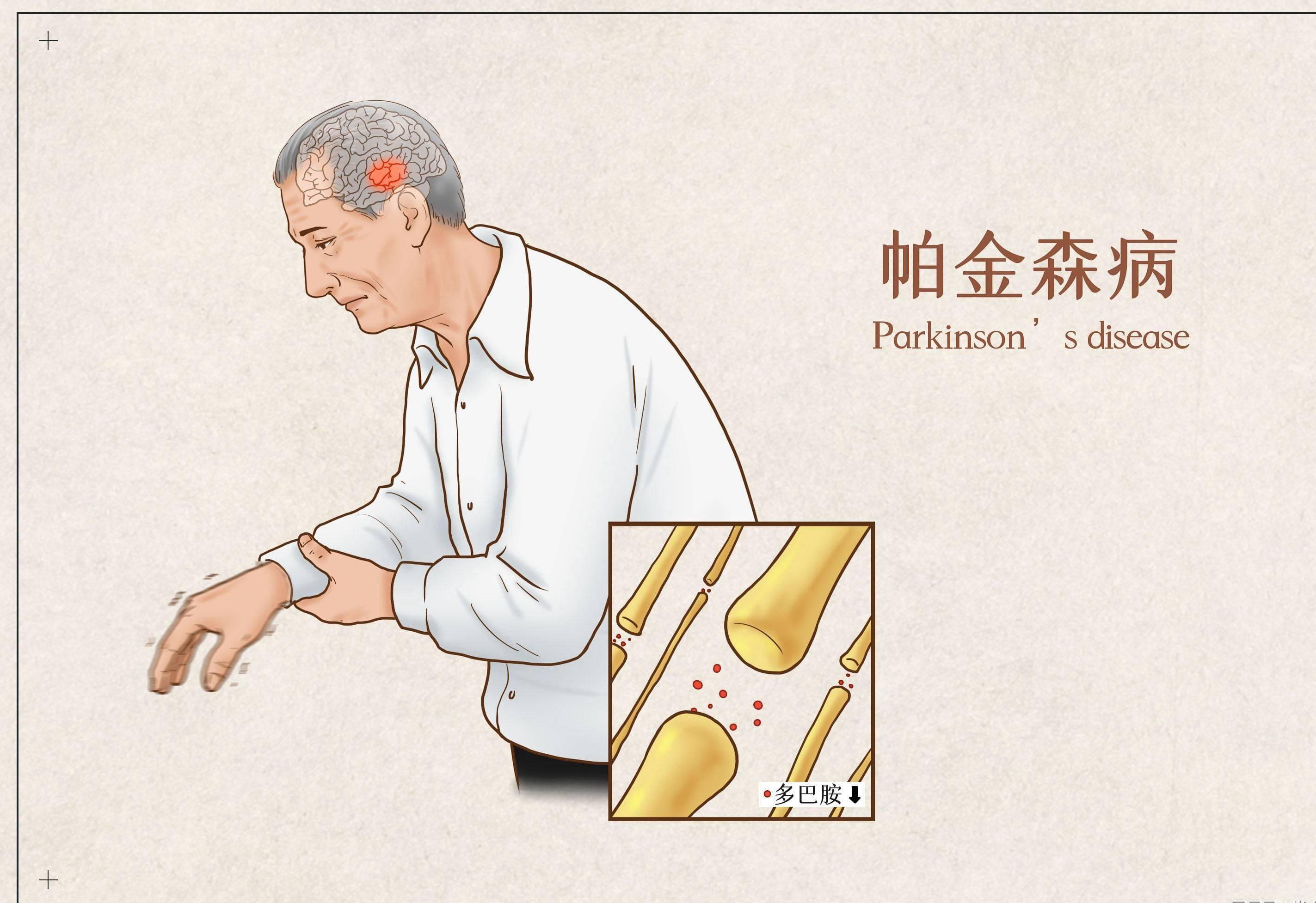 健康小贴士:帕金森患者饮食中的"黑名单"