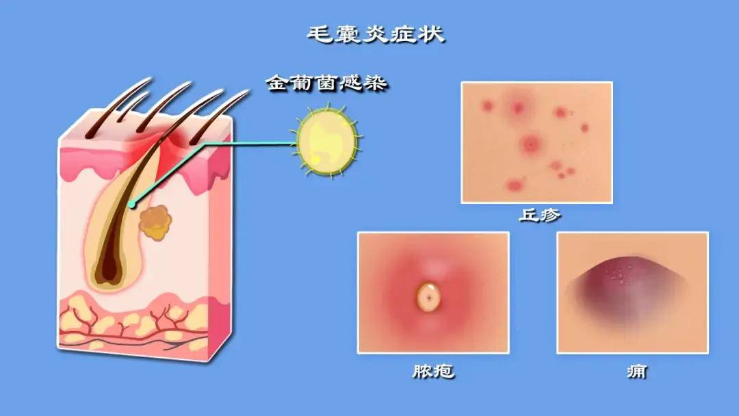 龙须疮的症状图片图片