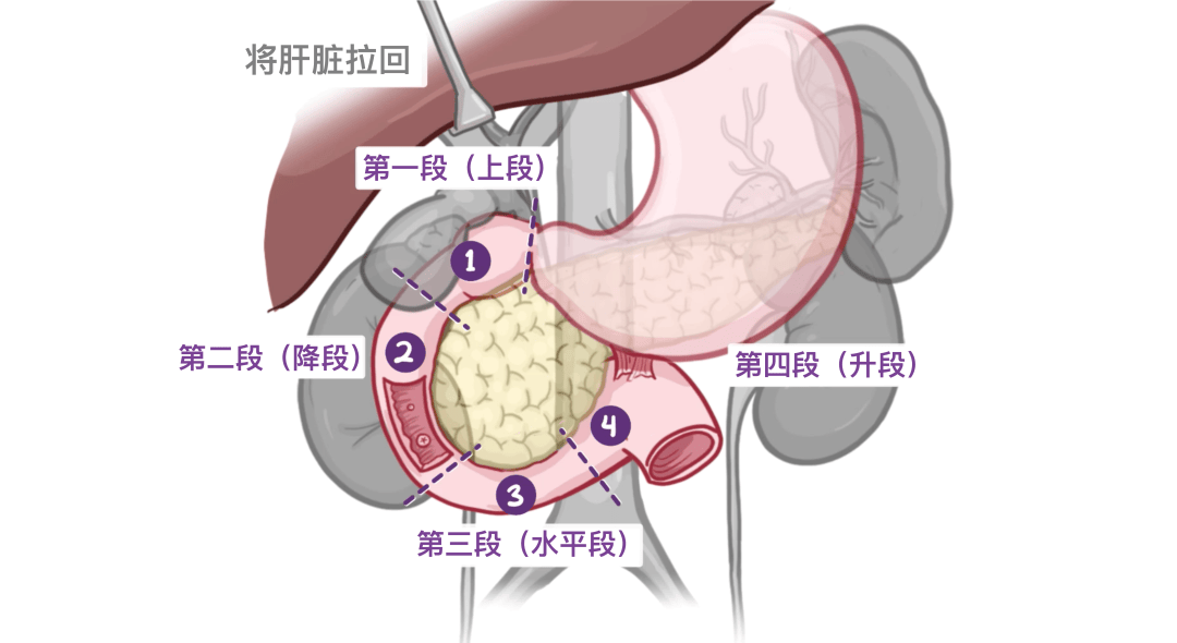 十二指肠的形状像字母c,围绕胰头弯曲,包括第一段(上段),第二段(降段)