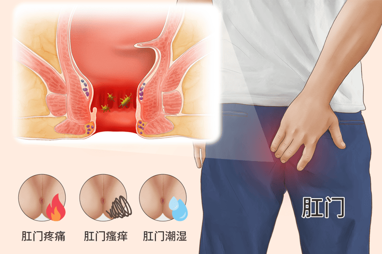 肛管癌的早期症状图片图片