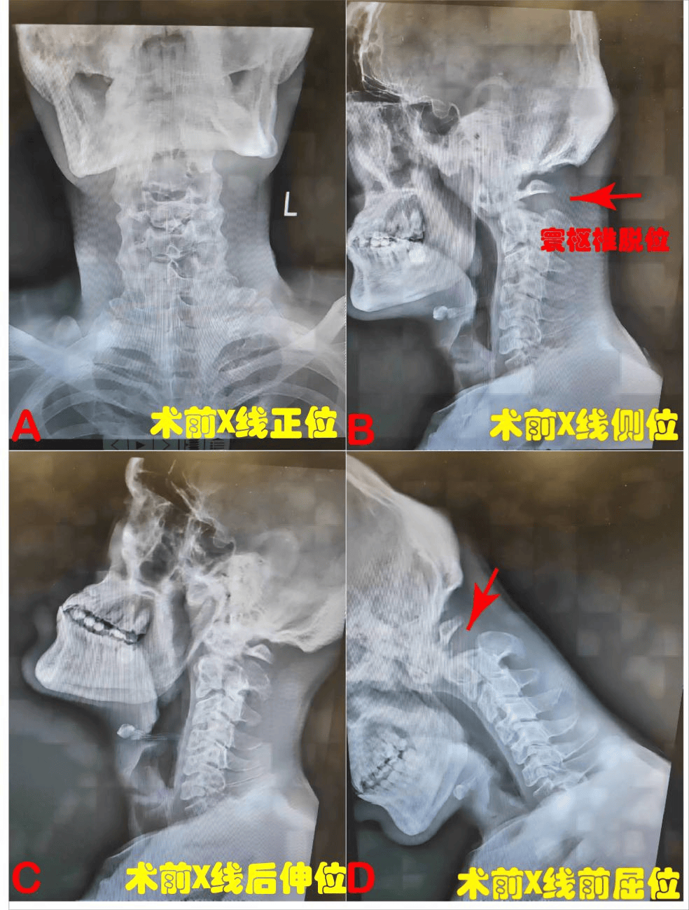 枢椎棘突图片