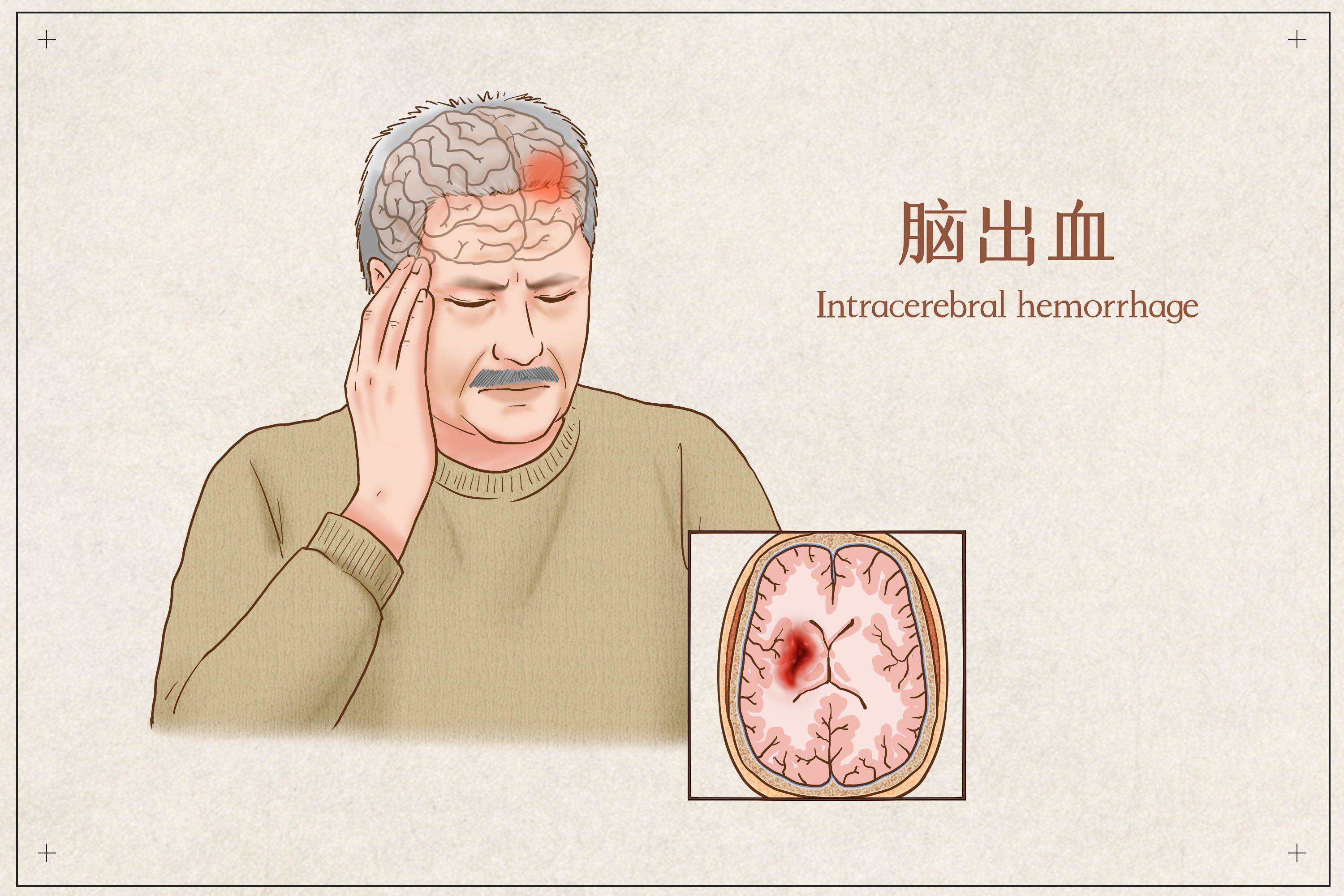 脑出血后遗症治疗:时机,决定康复的关键