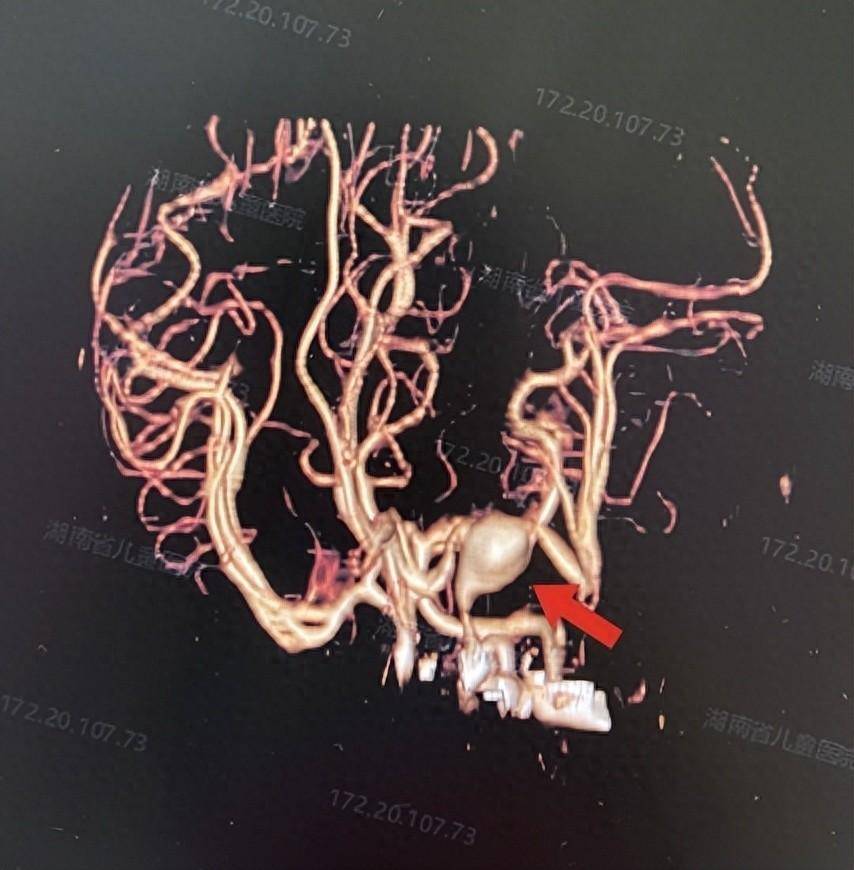脑动脉瘤介入栓塞术图图片