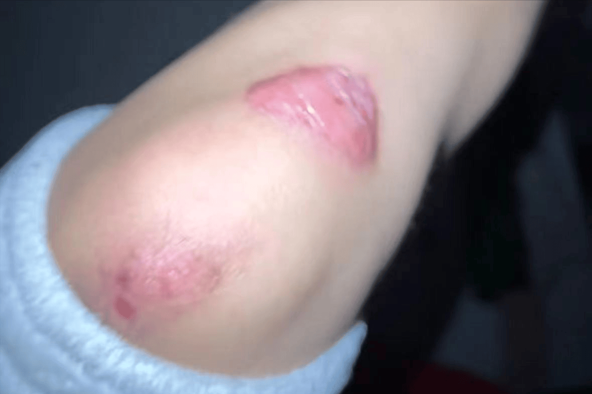 疤痕增生终于解决了!