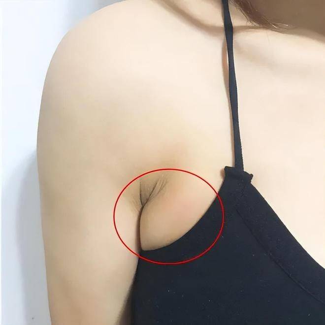 橘皮样乳房 症状图片