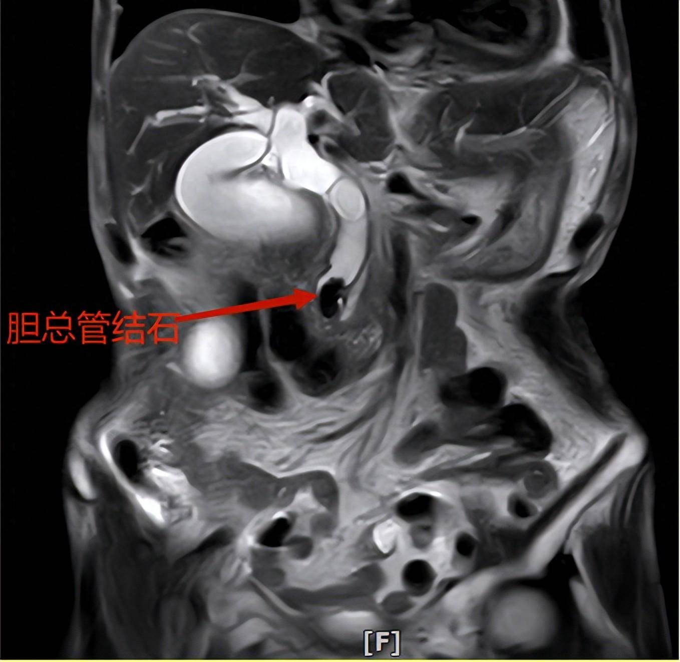 胆道胰腺疾病微创治疗的利器"ercp",您了解吗?