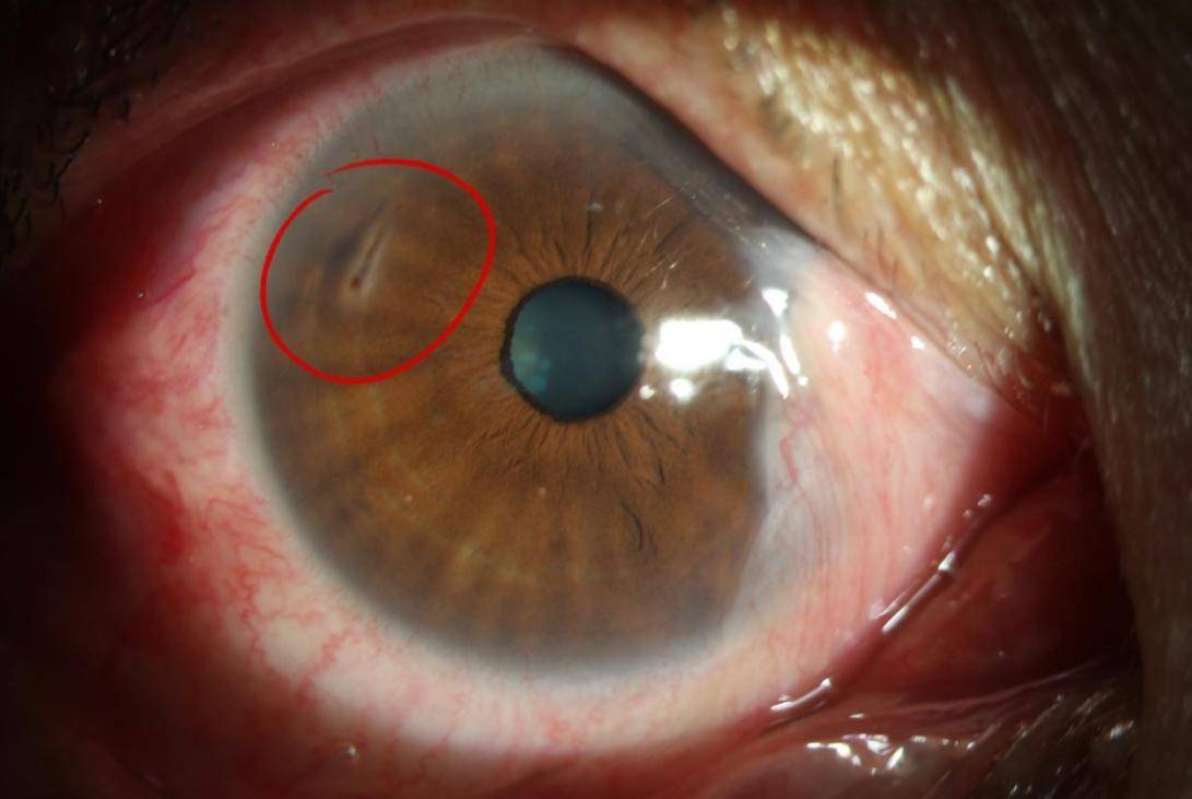 眼睛虹膜断裂图片