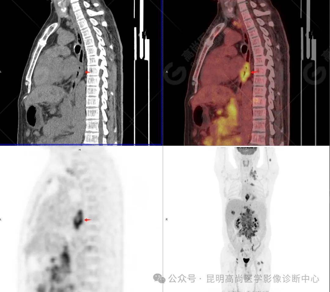 pet-ct-冠状位pet-ct-轴位检查图像患者,男,42岁;2024年春节期间,开始