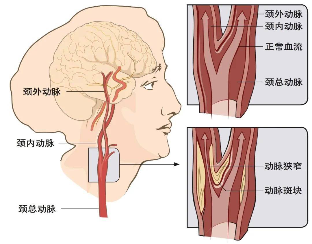 查出颈动脉斑块,狭窄怎么办?要做手术吗?还能做颈部按摩吗?