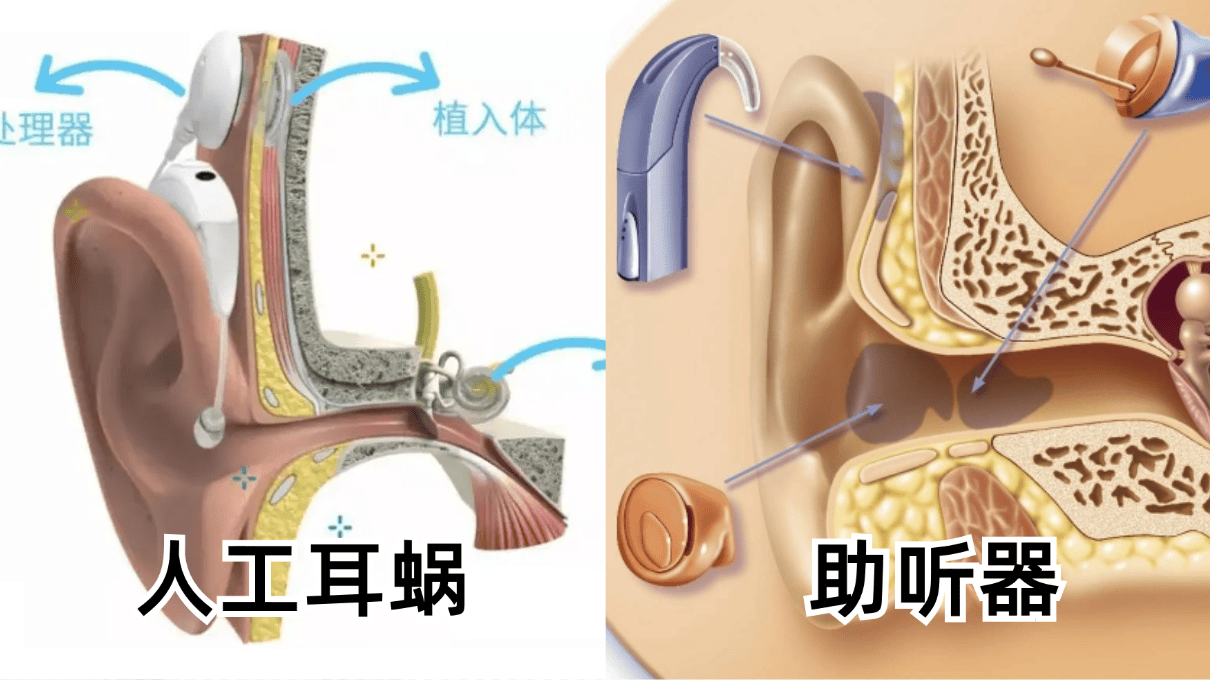 人工耳蜗示意图图片