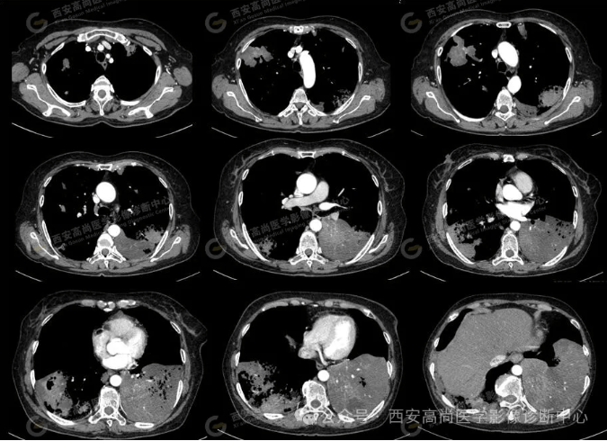 女,63岁,肺粘液腺癌一例