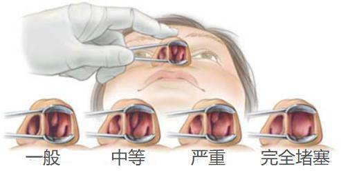 鼻窦炎分泌物图片