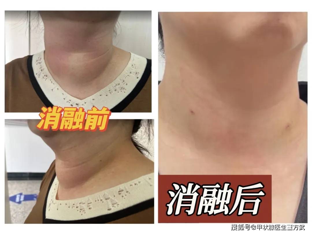3类甲状腺结节严重吗,还可以观察吗?