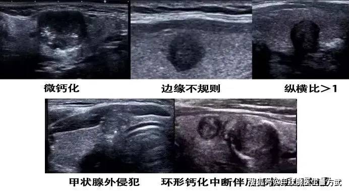 点状钙化图片图片