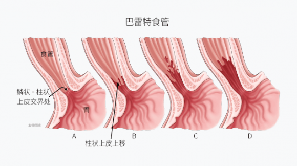 中国巴雷特食管癌变率图片