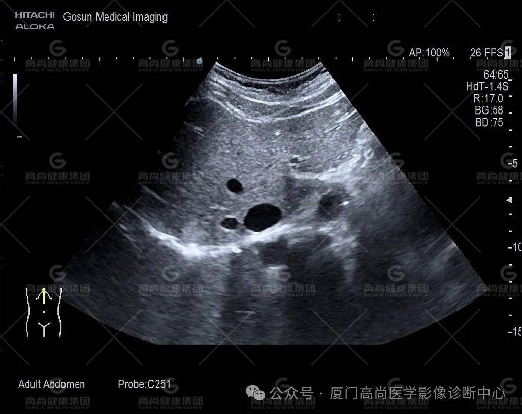 血肿机化超声图片图片