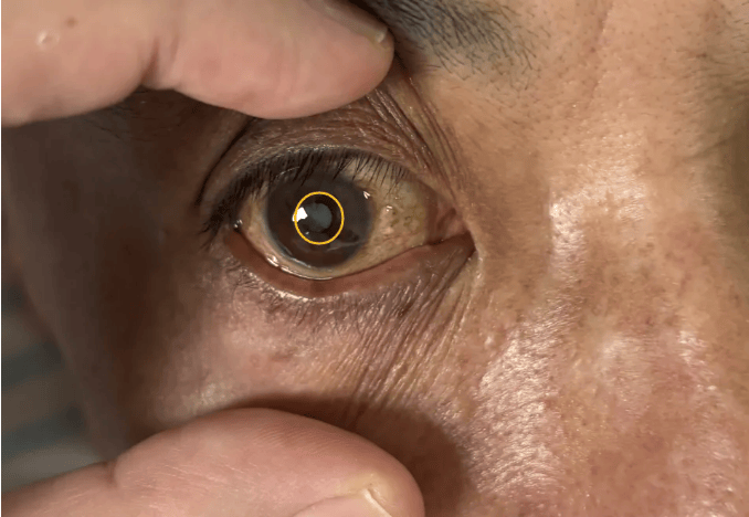 【点亮希望之光】彭州磊络福兴医院高位截瘫患者白内障术后重拾光明!