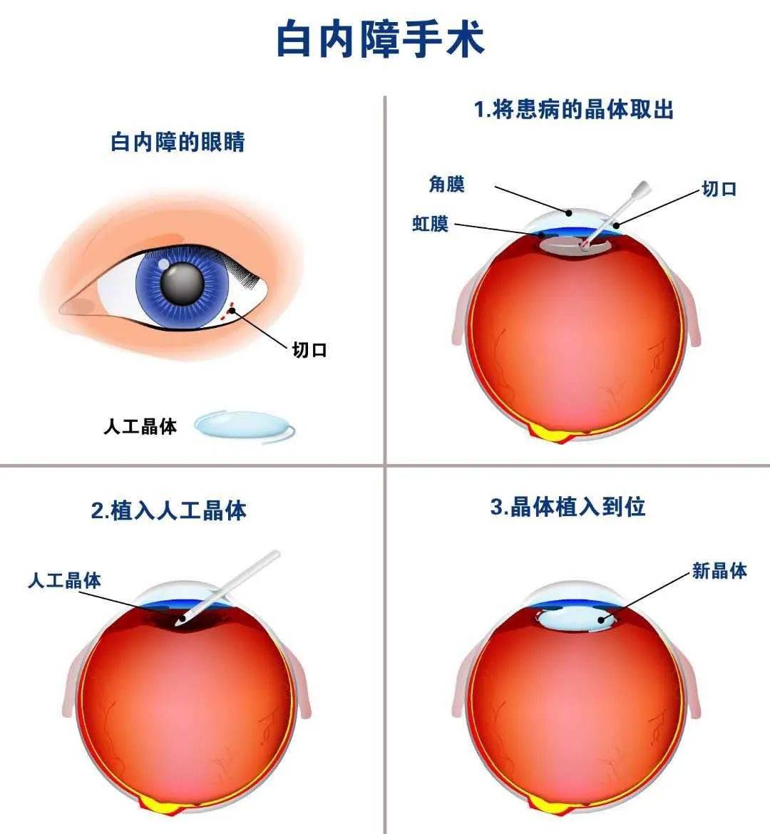 有虹视症状,看到光线周围有彩色晕光;■ 单眼有复视症状,一只眼睛