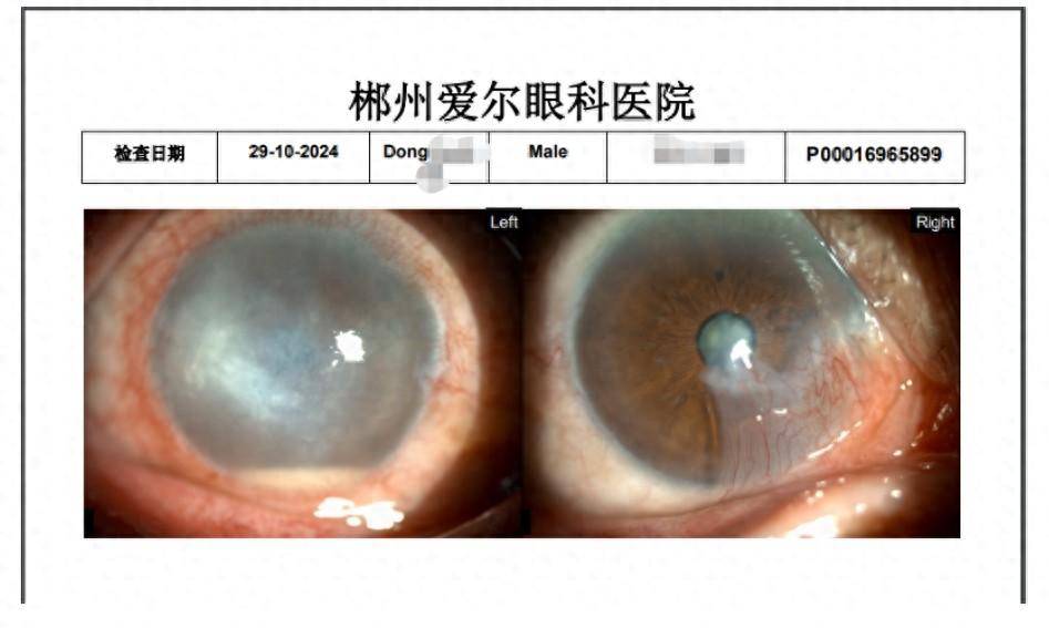 叔叔_角膜_眼睛