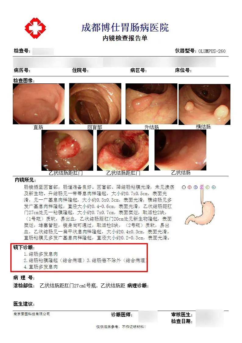 肠癌粘液便特点图片