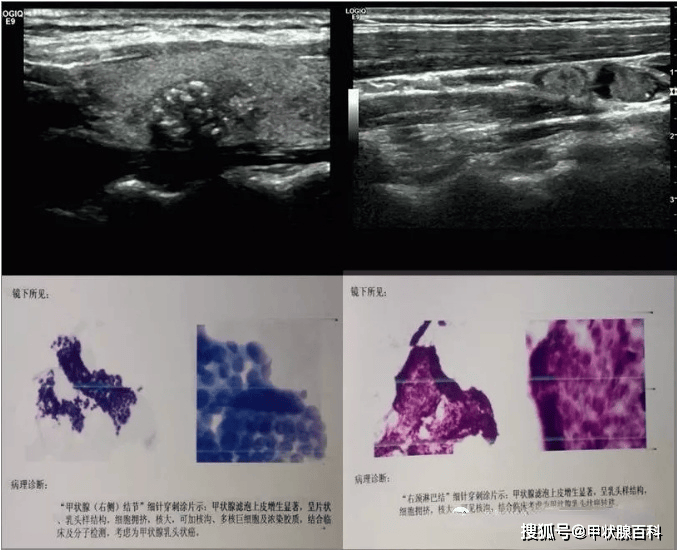甲状软骨超声图像图片