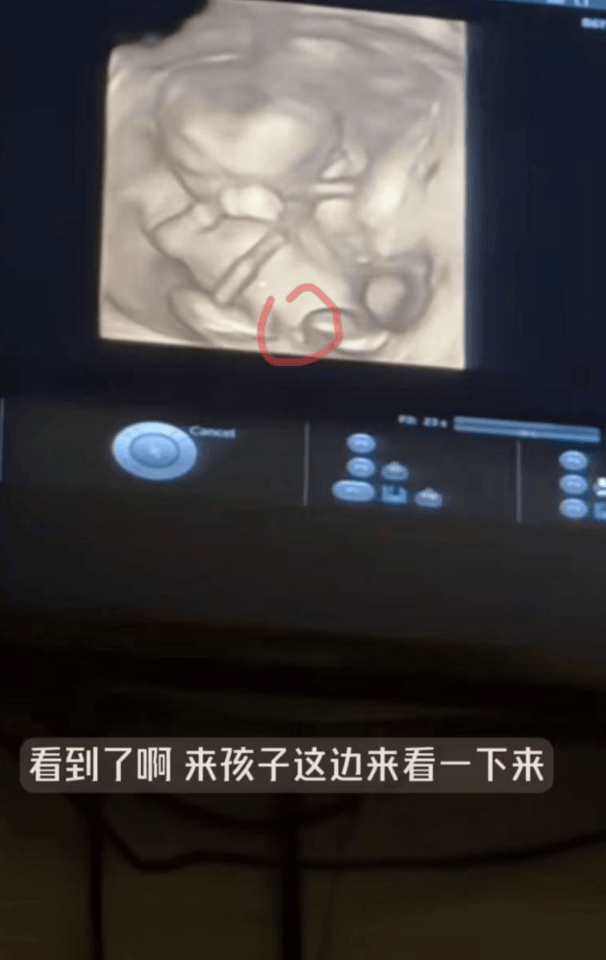张檬去香港产检,b超看出是男孩,但脱鞋称体重时,拇外翻好明显