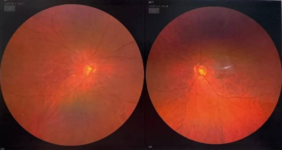 眼部b超:双眼玻璃体混浊,后脱离.眼轴长度:右眼:27.28mm;左眼:27